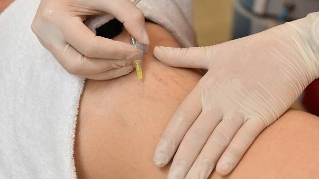 Renova | Carboxiterapia